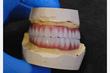 Alanya'da Tam Seramik Kaplama ile Hollywood Gülüşü Elde Etmek - Moon Dental Alanya Blog